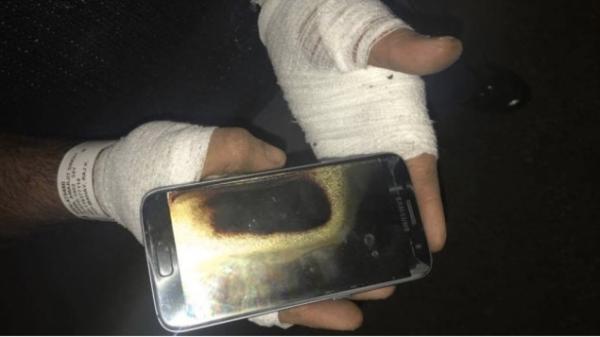 Amarjit Mann的手和手腕均被燒傷。來源：Gizmodo
