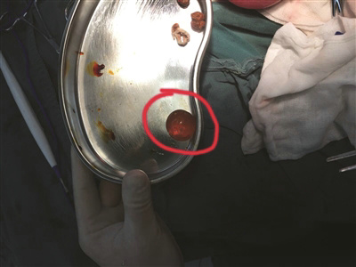 醫生從孩子體內取出已膨脹至乒乓球大小的“水寶寶”（醫院供圖）