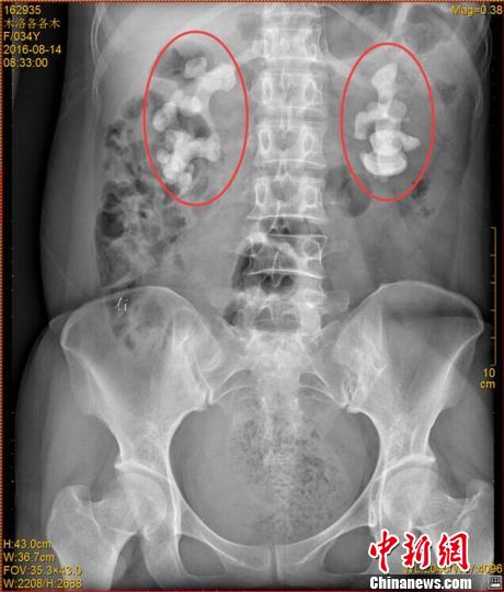 四川一女子喝生水30餘年雙腎長10釐米巨型結石