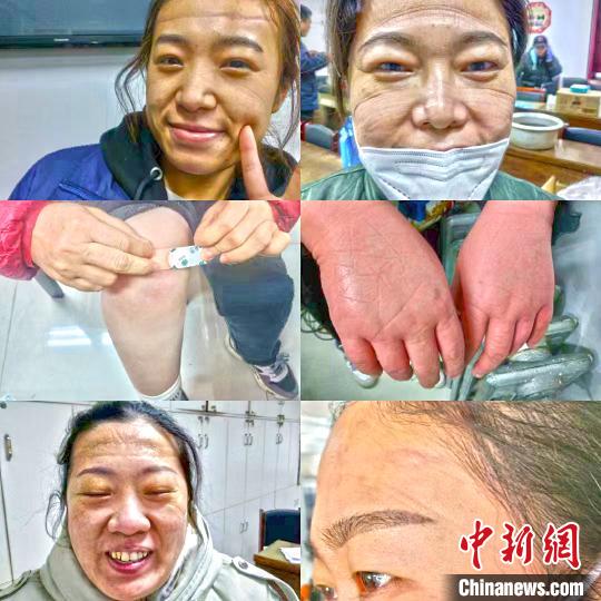 核酸採樣手“凍成饅頭”，這些醫護人員説……