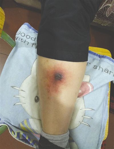 羅先生被蟲咬了之後，腿部開始潰爛