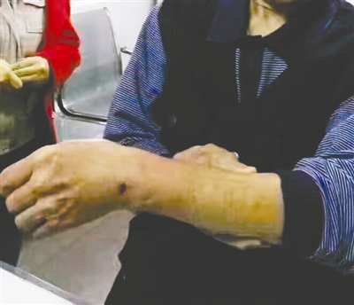 一位市民的手背被咬傷
