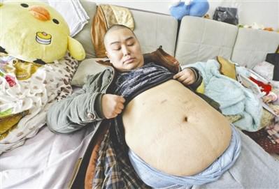 2017年2月3日，胖哥張濤（化名）展示自己手術的刀口，基本上沒有痕跡。