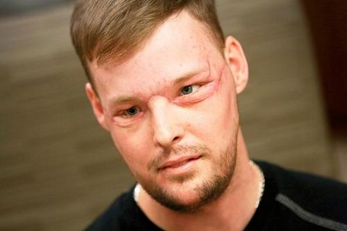 美國男子吞槍臉全毀10年後“換臉”獲新生（圖）