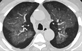 中、下肺軸位CT平掃顯示毛玻璃樣混濁伴胸膜下保留。(同一病人CT影像)