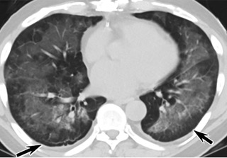 中、下肺軸位CT平掃顯示毛玻璃樣混濁伴胸膜下保留(箭頭)。(同一病人CT影像)